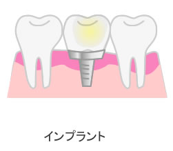 インプラントによる治療