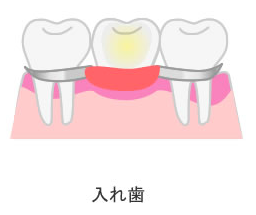 入れ歯による治療