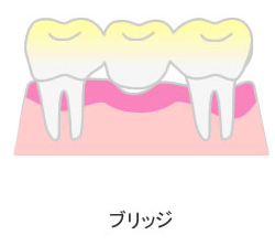 ブリッジによる治療